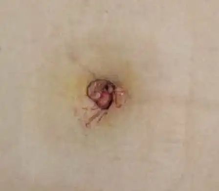 单孔腹腔镜切除卵巢囊肿,寿光哪里做皮脂腺囊肿手术