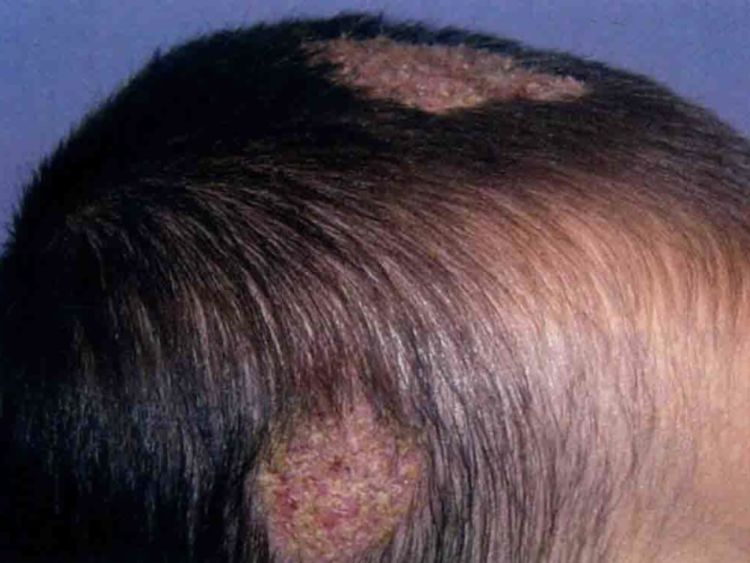 4岁儿童突然脱发严重是怎么回事,4岁儿童脱发严重该怎么办