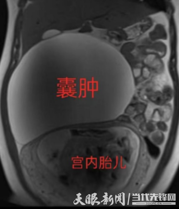 湄潭家礼医院：肚脐眼上开孔摘除20厘米巨大囊肿，成功保胎！